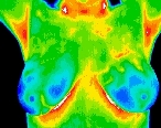 Breast Thermography Normal